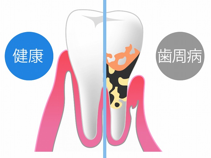 歯周病治療について