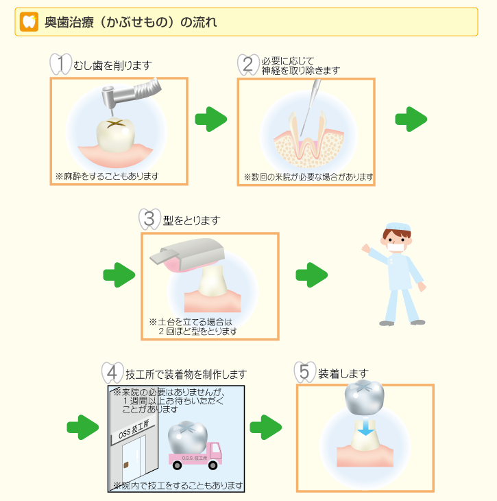 奥歯の被せ物